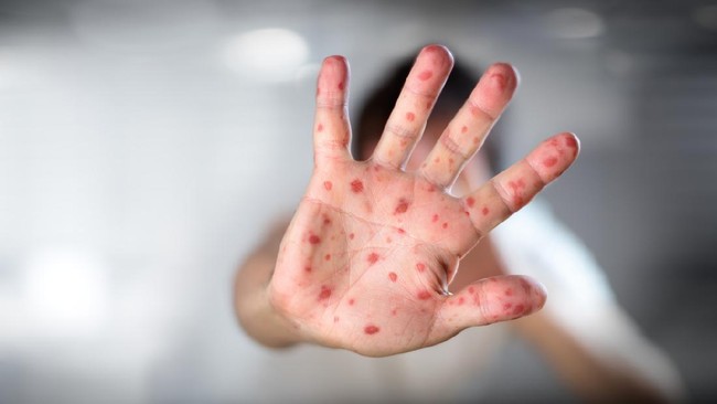 Wabah campak di Meksiko menewaskan empat orang tahun ini, termasuk tiga anak yang tidak divaksinasi. Ilustrasi. (iStockphoto/RomoloTavani).